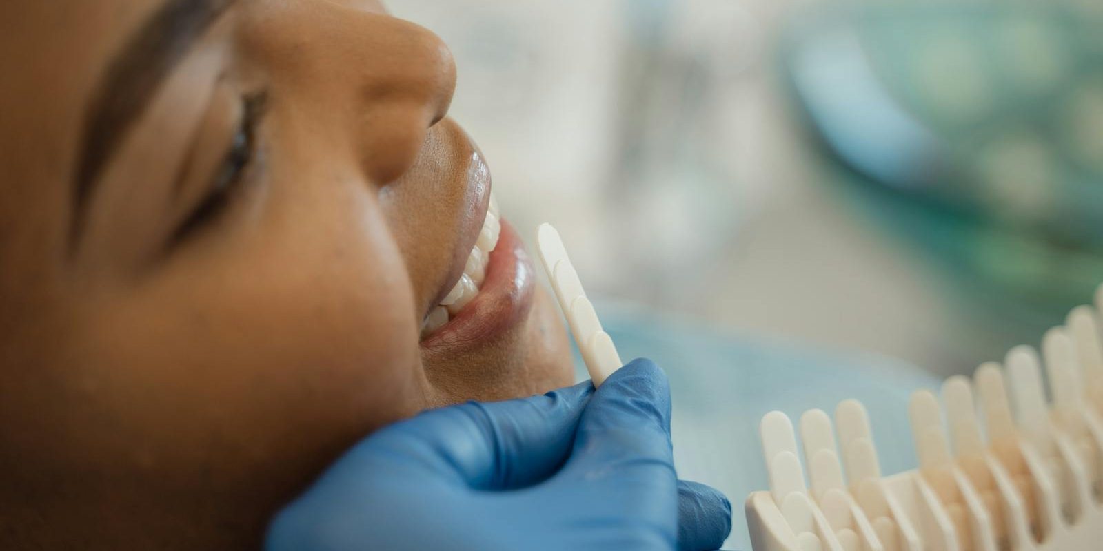 Teeth Whitening in Corona, CA: What Are Your Options?